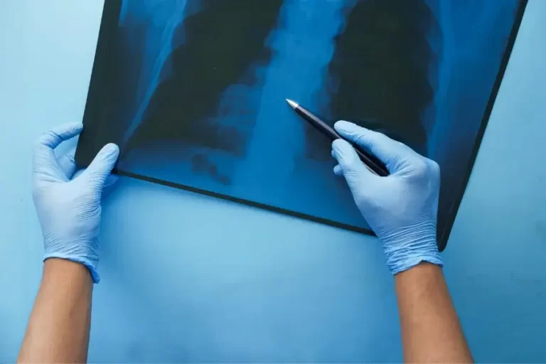 tuberculosis reiteramos informes